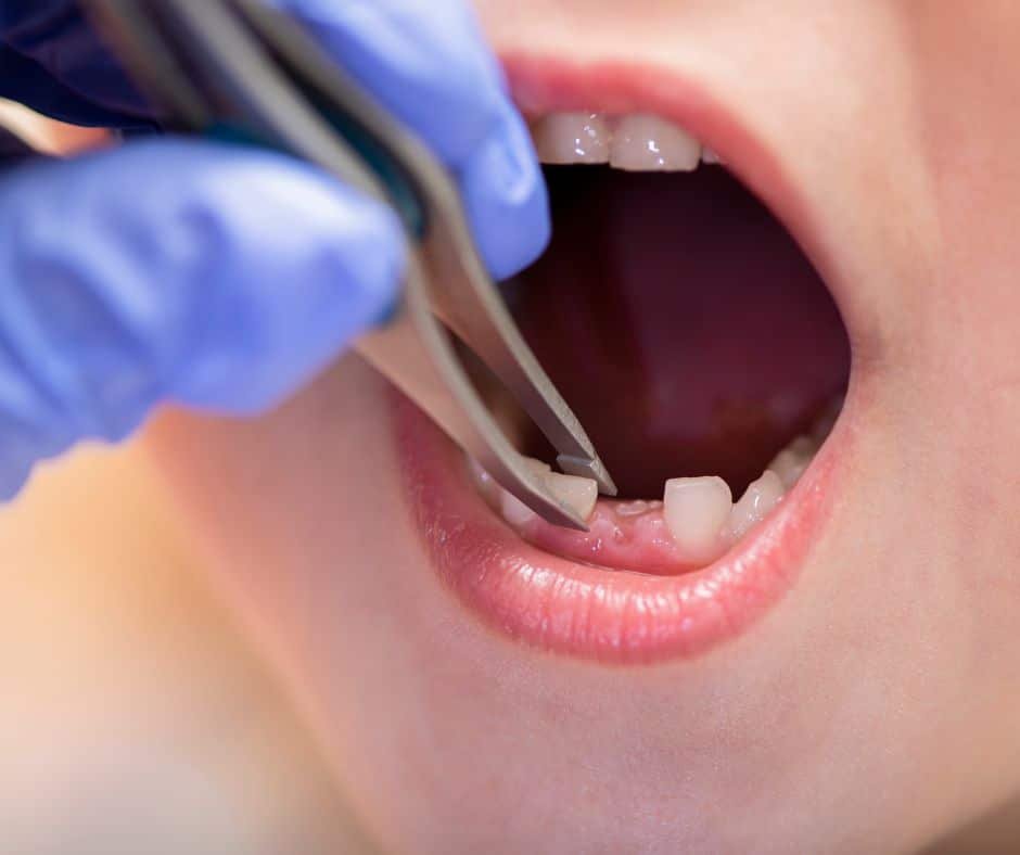 double teeth in kids 