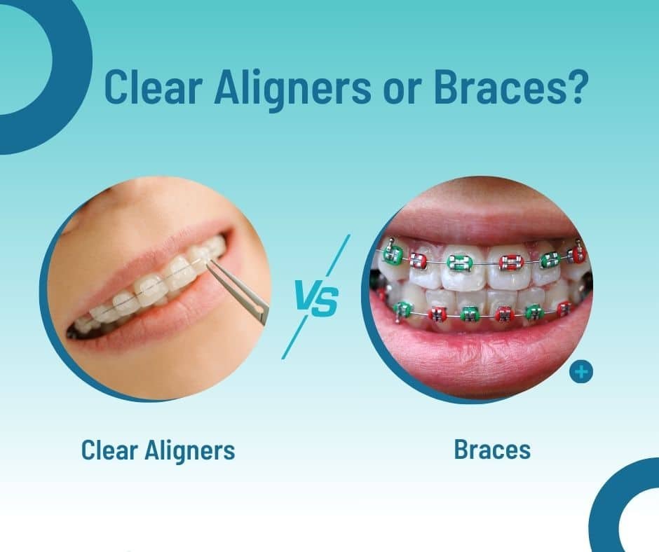 Clear-Aligners-or-Braces