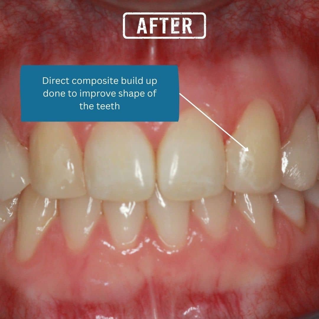 Post After – 32 Smile Design