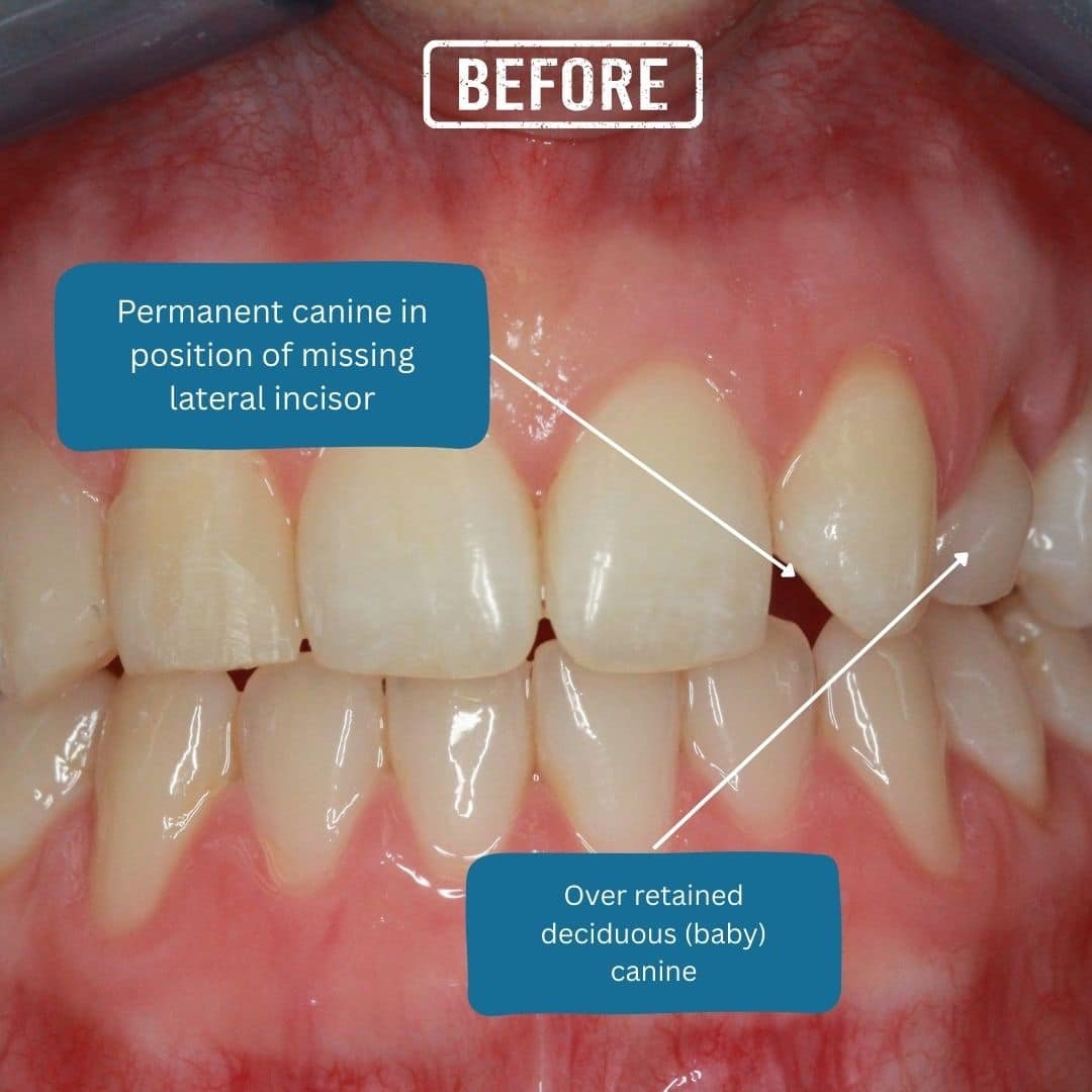 Post Before – 32 Smile Design