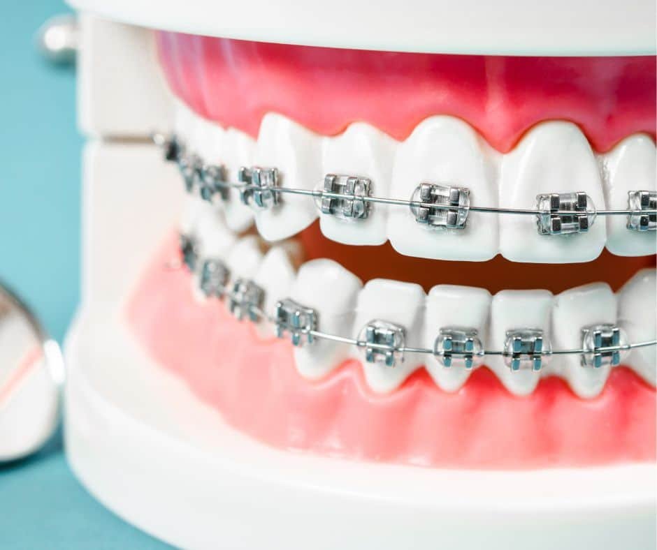 metal braces-32-Smile-Design