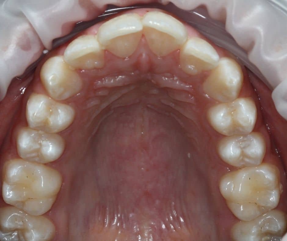 10 Braces Patient4 Before UpperJaw &ndash; 32 Smile Design
