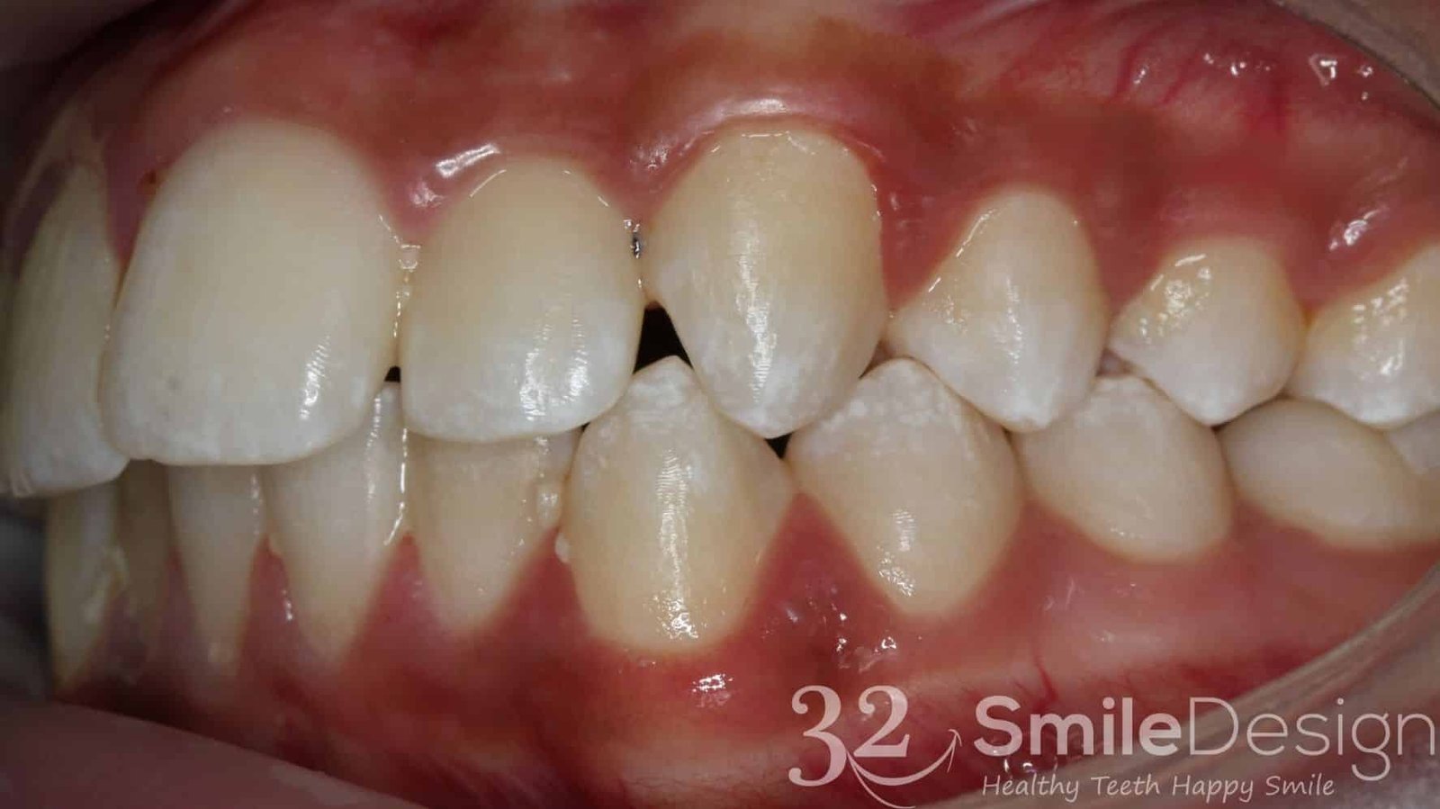 1 Braces Patient 4 Before leftside &ndash; 32 Smile Design