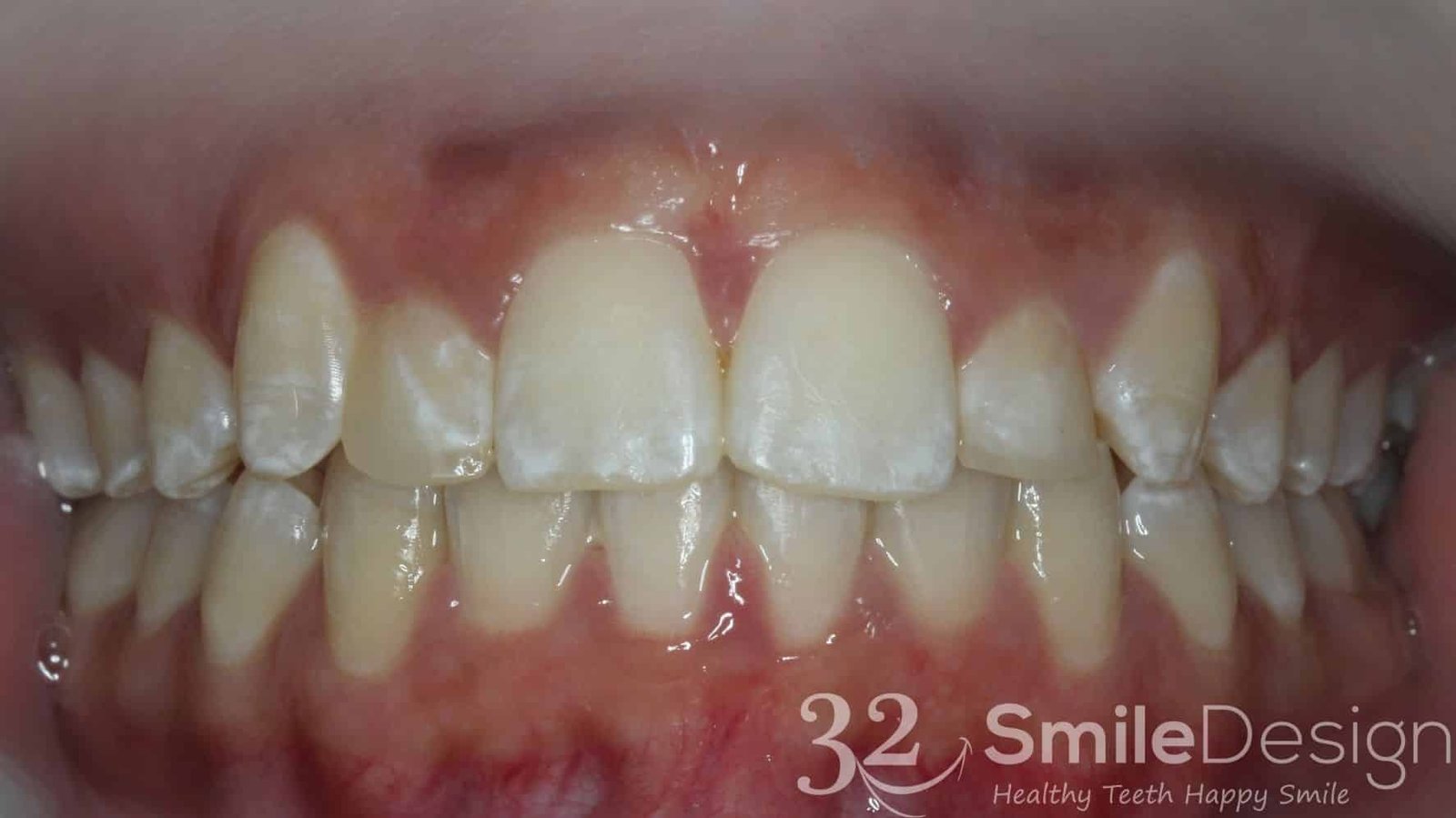 1 Braces Patient 5 After frontbite closed &ndash; 32 Smile Design