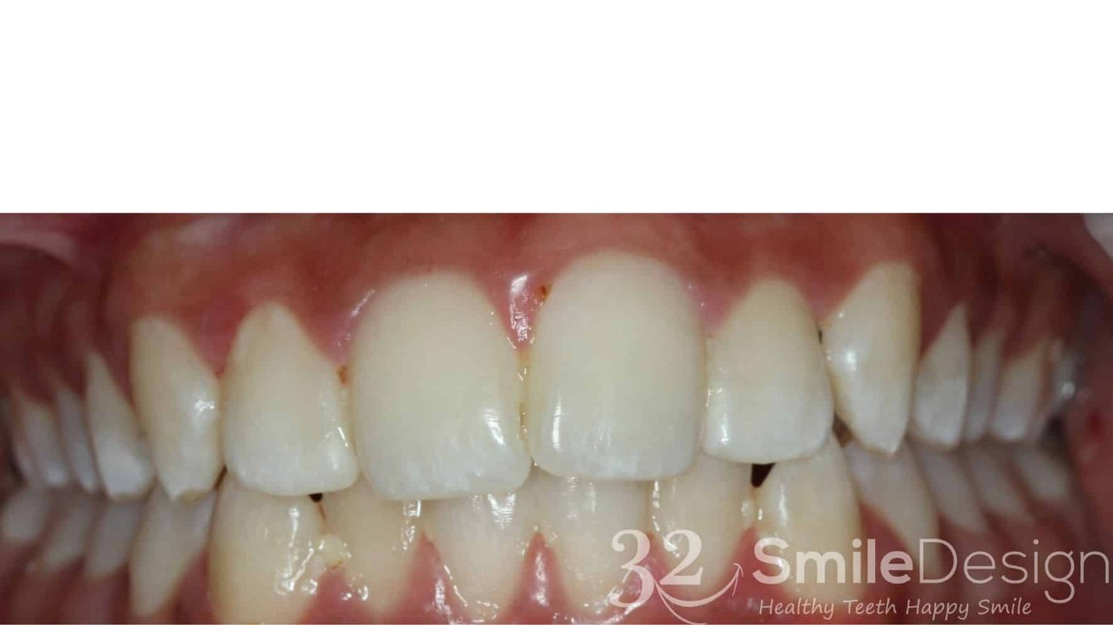 2 Braces Patient 4 Beforefrontbite closed &ndash; 32 Smile Design