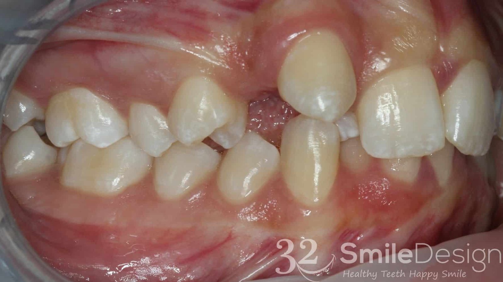 2 Braces Patient 5 Before rightside &ndash; 32 Smile Design