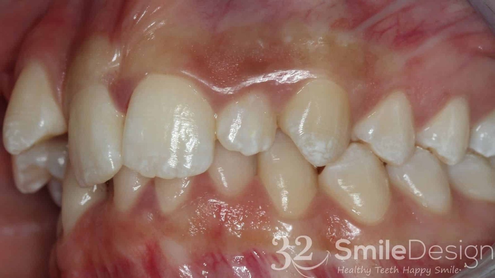 3 Braces Patient 5 Before leftside &ndash; 32 Smile Design