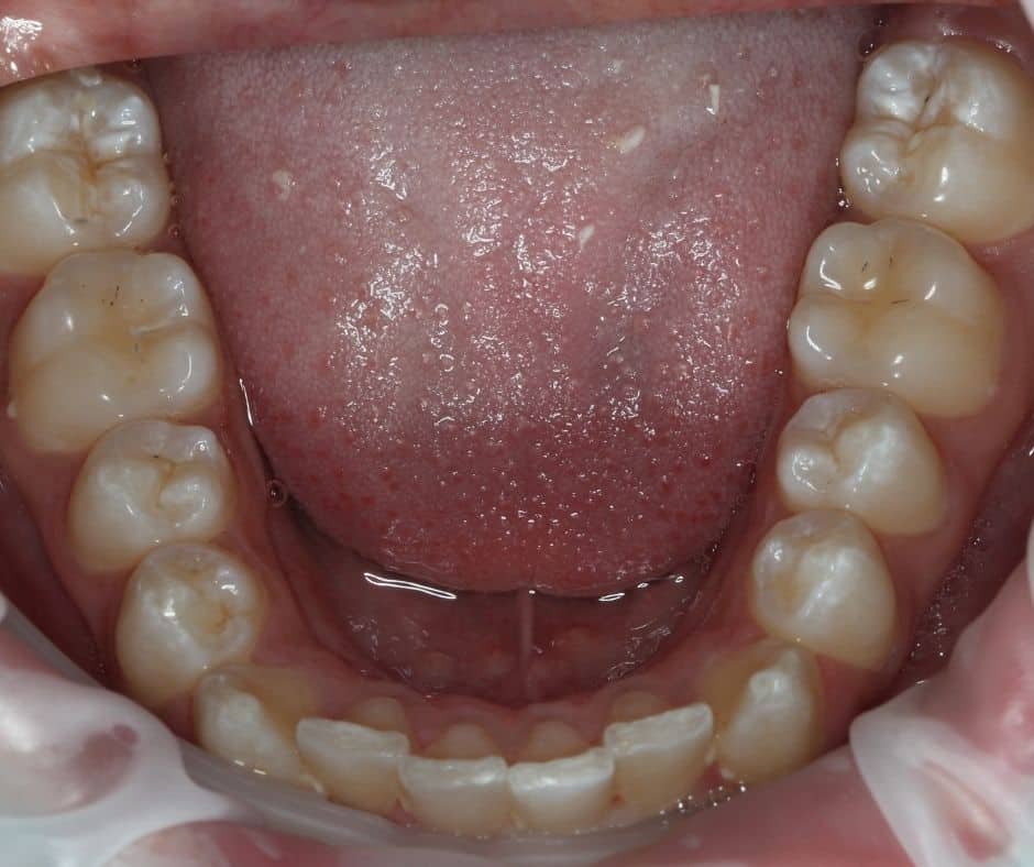 3 Braces Patient4 Before LowerJaw &ndash; 32 Smile Design