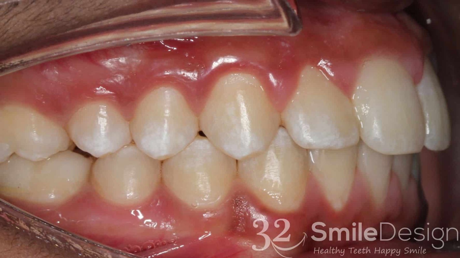 4 Braces Patient 4 After rightside &ndash; 32 Smile Design
