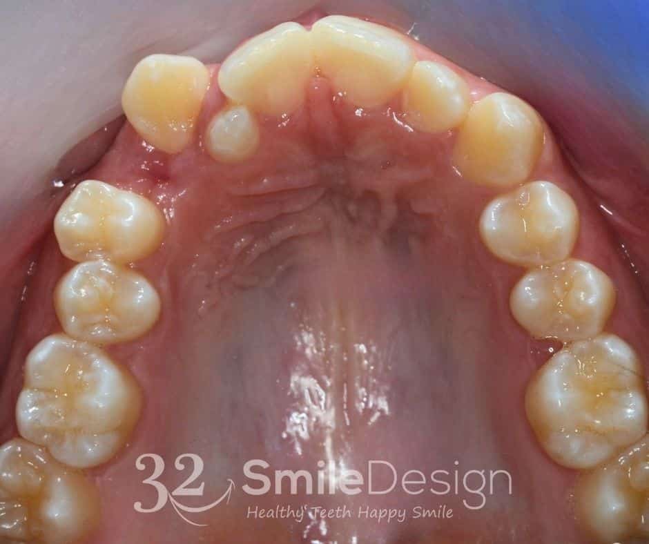 4 Braces Patient5 Before UpperJaw &ndash; 32 Smile Design