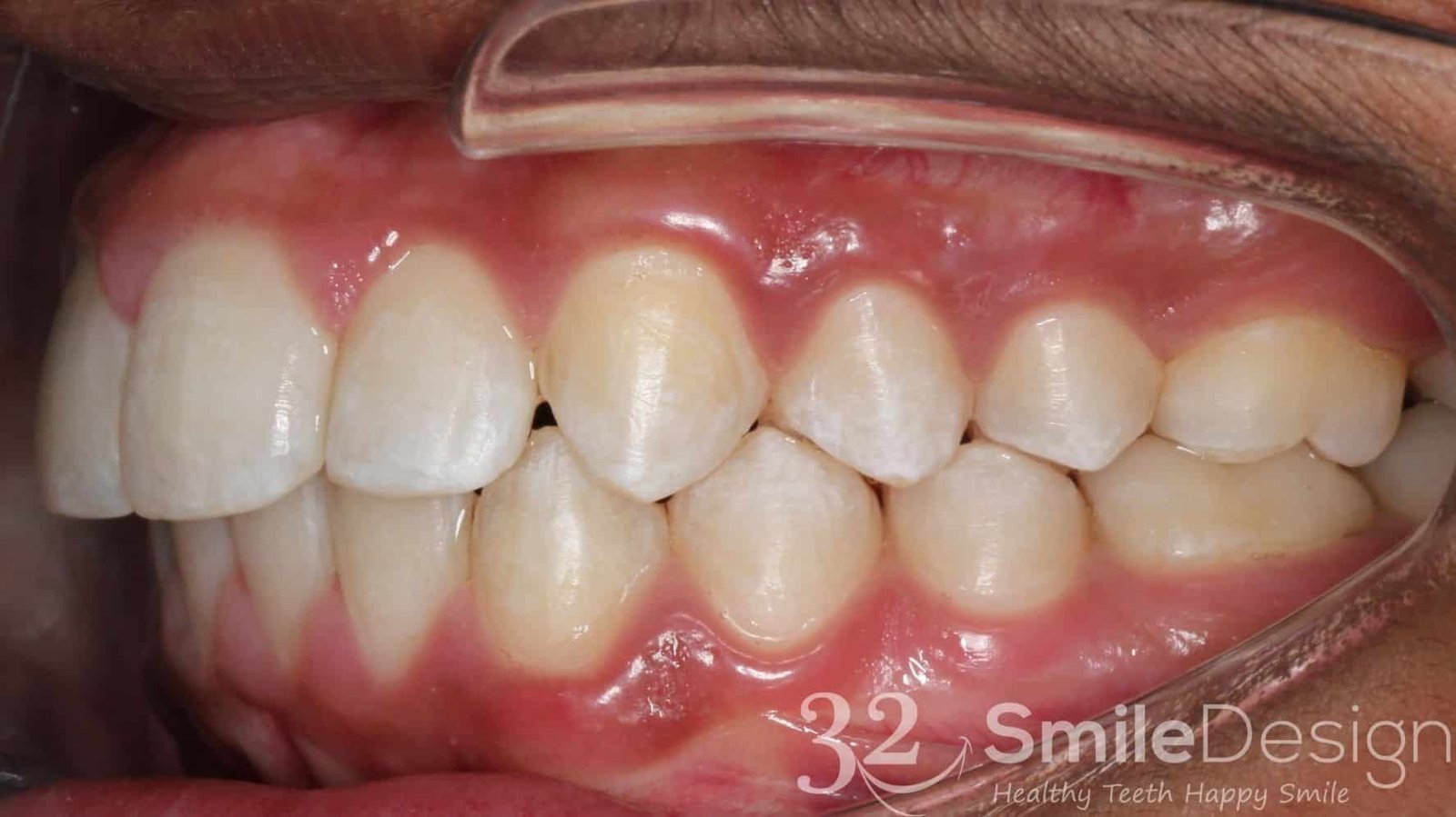 5 Braces Patient 4 After leftside &ndash; 32 Smile Design