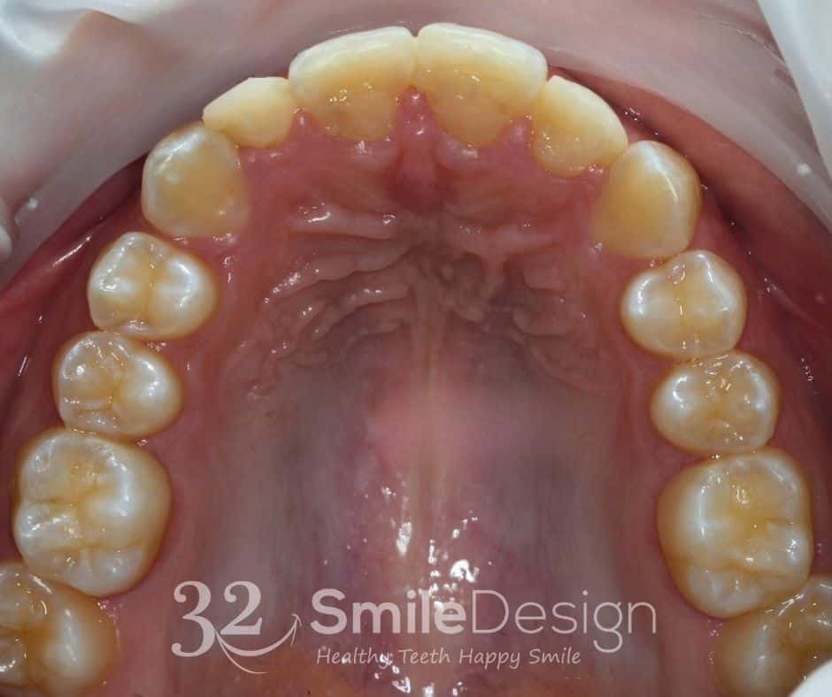 5 Braces Patient5 After UpperJaw &ndash; 32 Smile Design