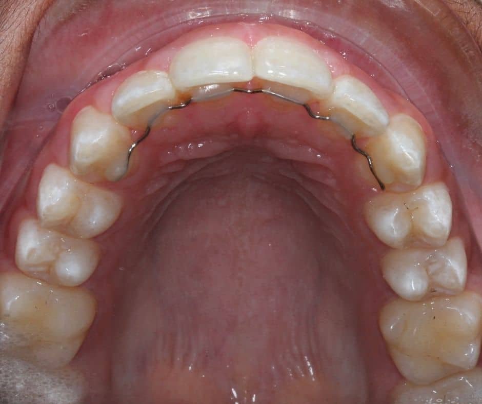 6 Braces Patient4 After UpperJaw &ndash; 32 Smile Design