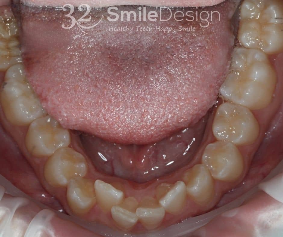 6 Braces Patient5 Before LowerJaw &ndash; 32 Smile Design