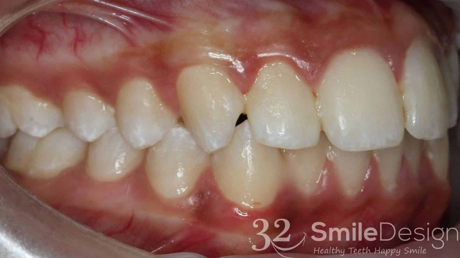 7 Braces Patient 4 Before rightside &ndash; 32 Smile Design