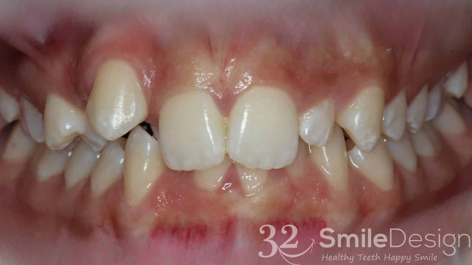 7 Braces Patient 5 Beforefrontbite closed &ndash; 32 Smile Design