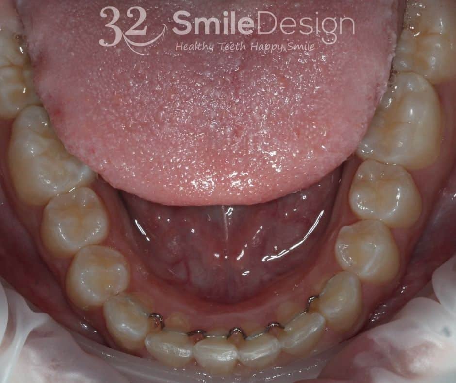 8 Braces Patient5 After LowerJaw &ndash; 32 Smile Design