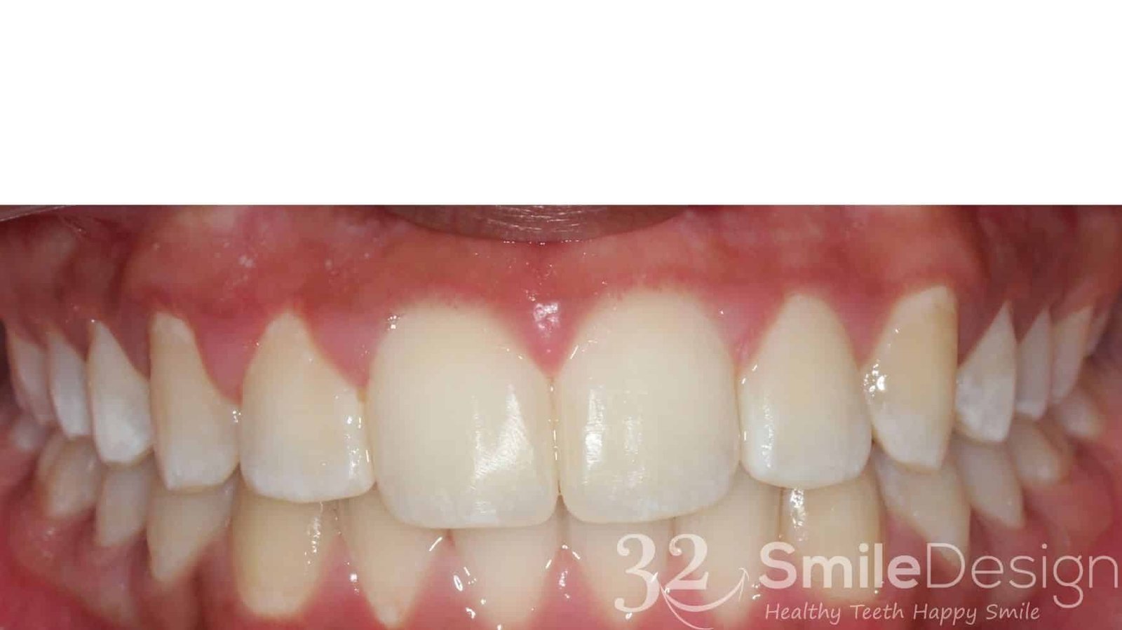 9 Braces Patient 4 After frontbite closed &ndash; 32 Smile Design