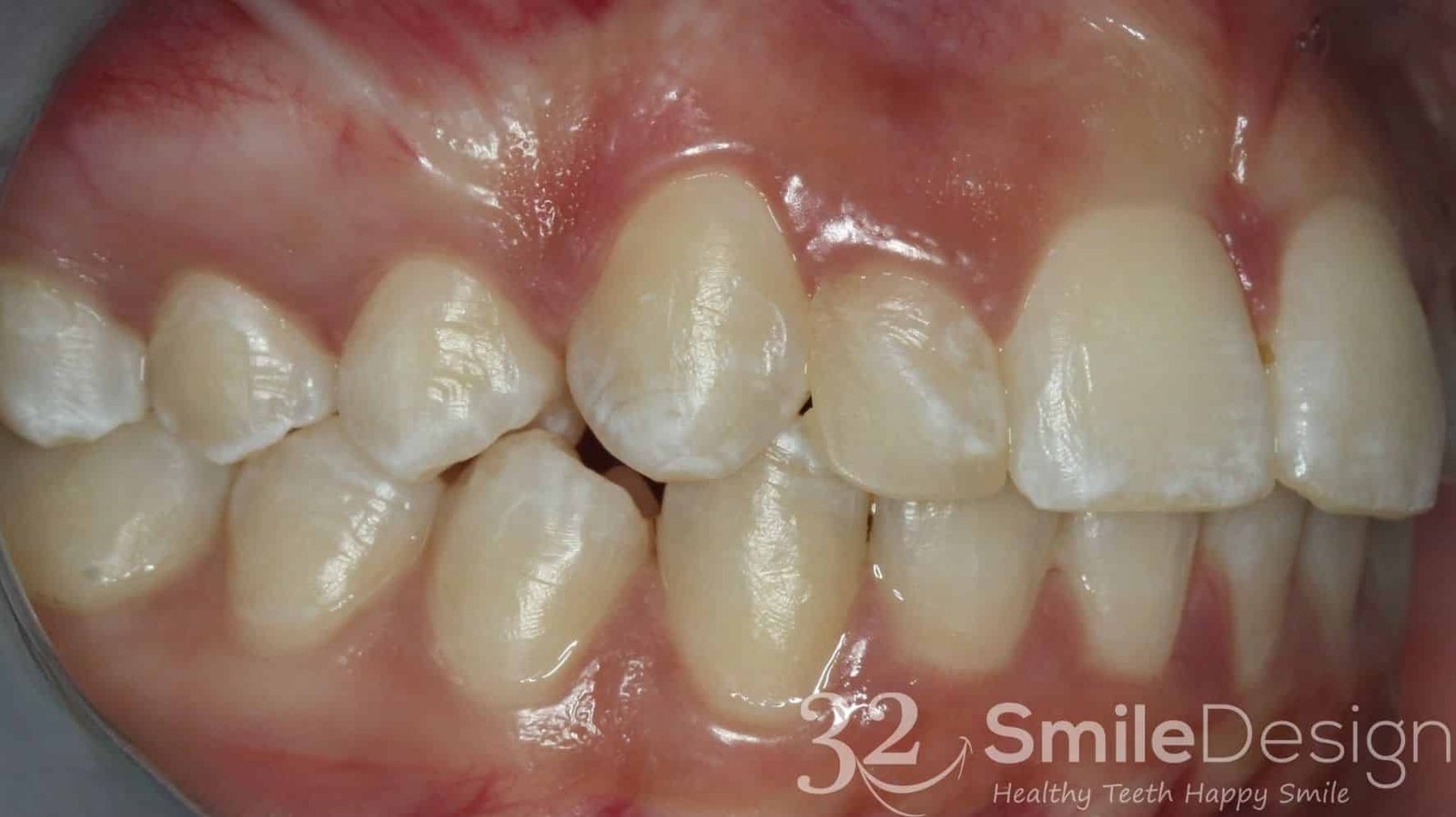9 Braces Patient 5 After rightside &ndash; 32 Smile Design