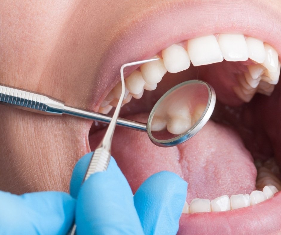 teeth cleaning 32 smile design