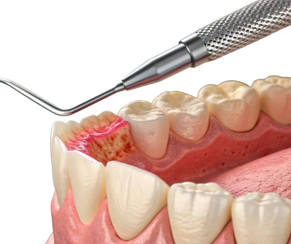 Gum Disease Treatment 32 Smile Design Gum-disease-treatment-32-Smile-Design