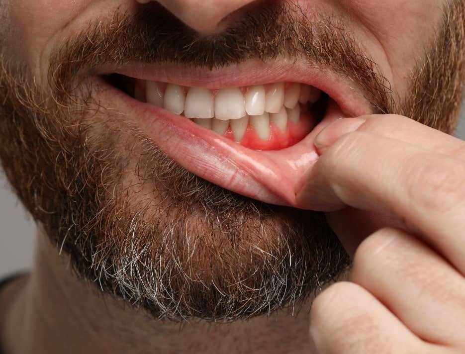 Gum Disease 32 Smile Design Gum disease 32 smile design